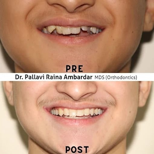 Dental Correction Case