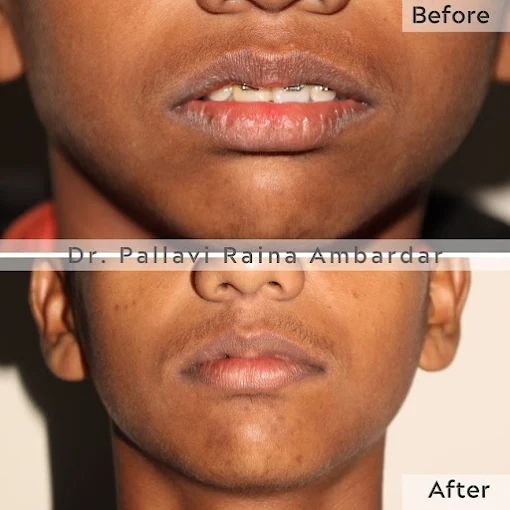 Smile Balance Treatment