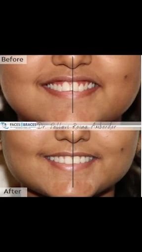 Orthodontic Treatment Result
