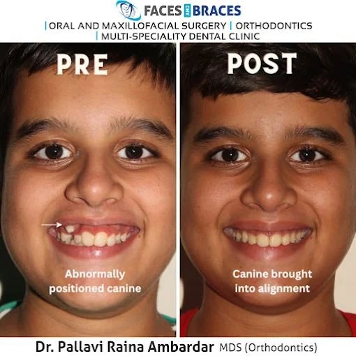 Smile Correction Result
