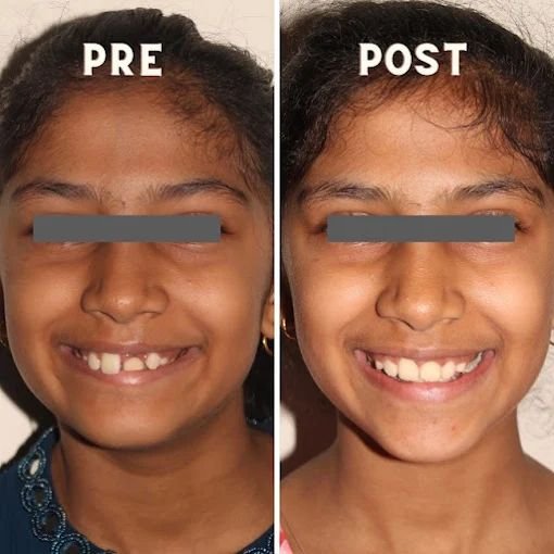 Smile Improvement Case