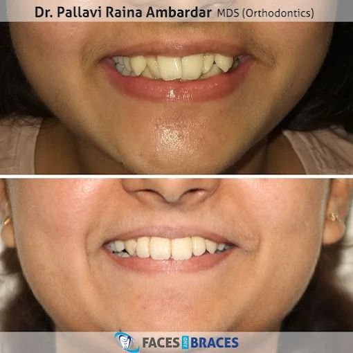 Dental Smile Enhancement