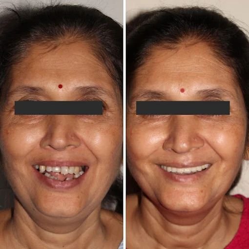 Orthodontic Smile Result