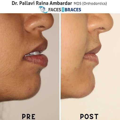 Jaw Profile Correction