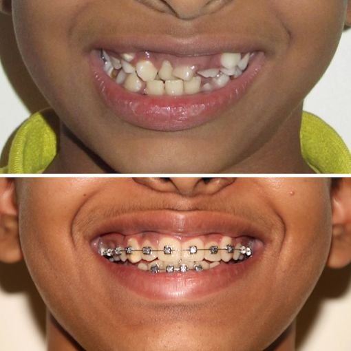 Orthodontic Smile Journey