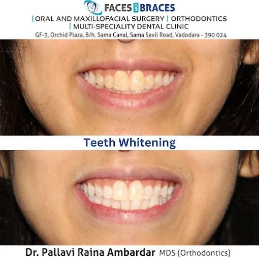 Smile Transformation