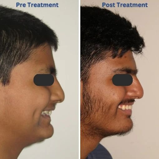 Facial Profile Improvement