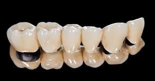 Crowns, Bridges, Veneers