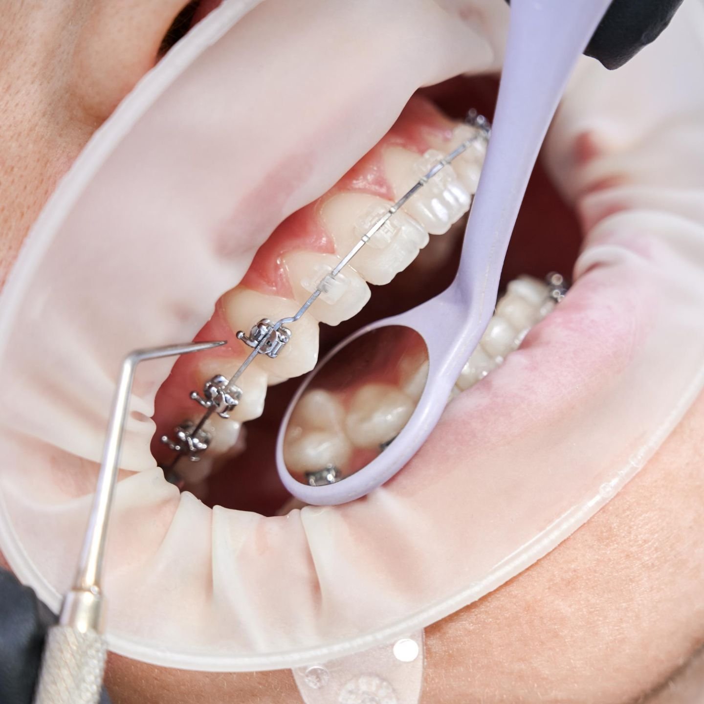 Orthodontics – Braces Treatment