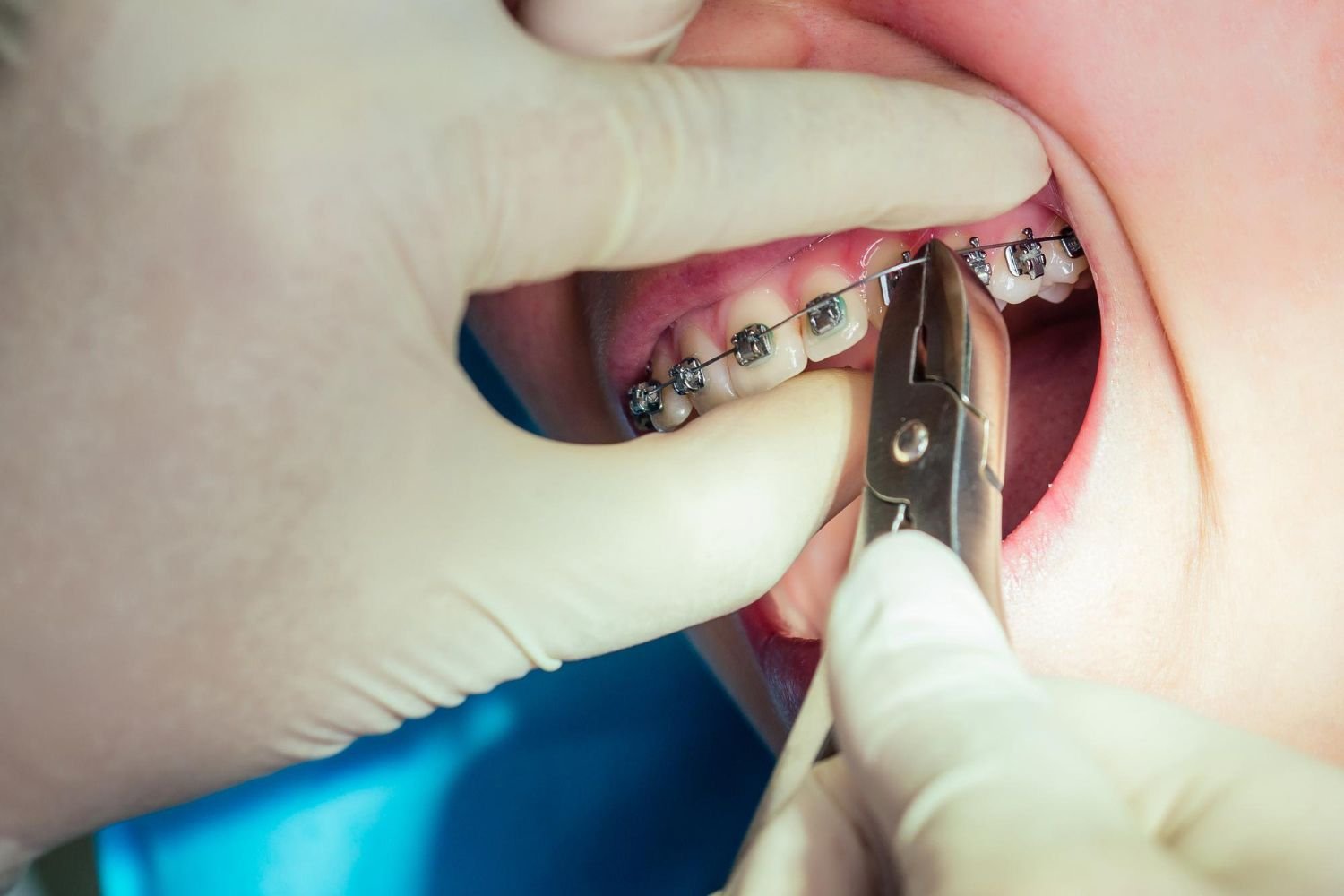 Signs You May Need Orthodontic Treatment
