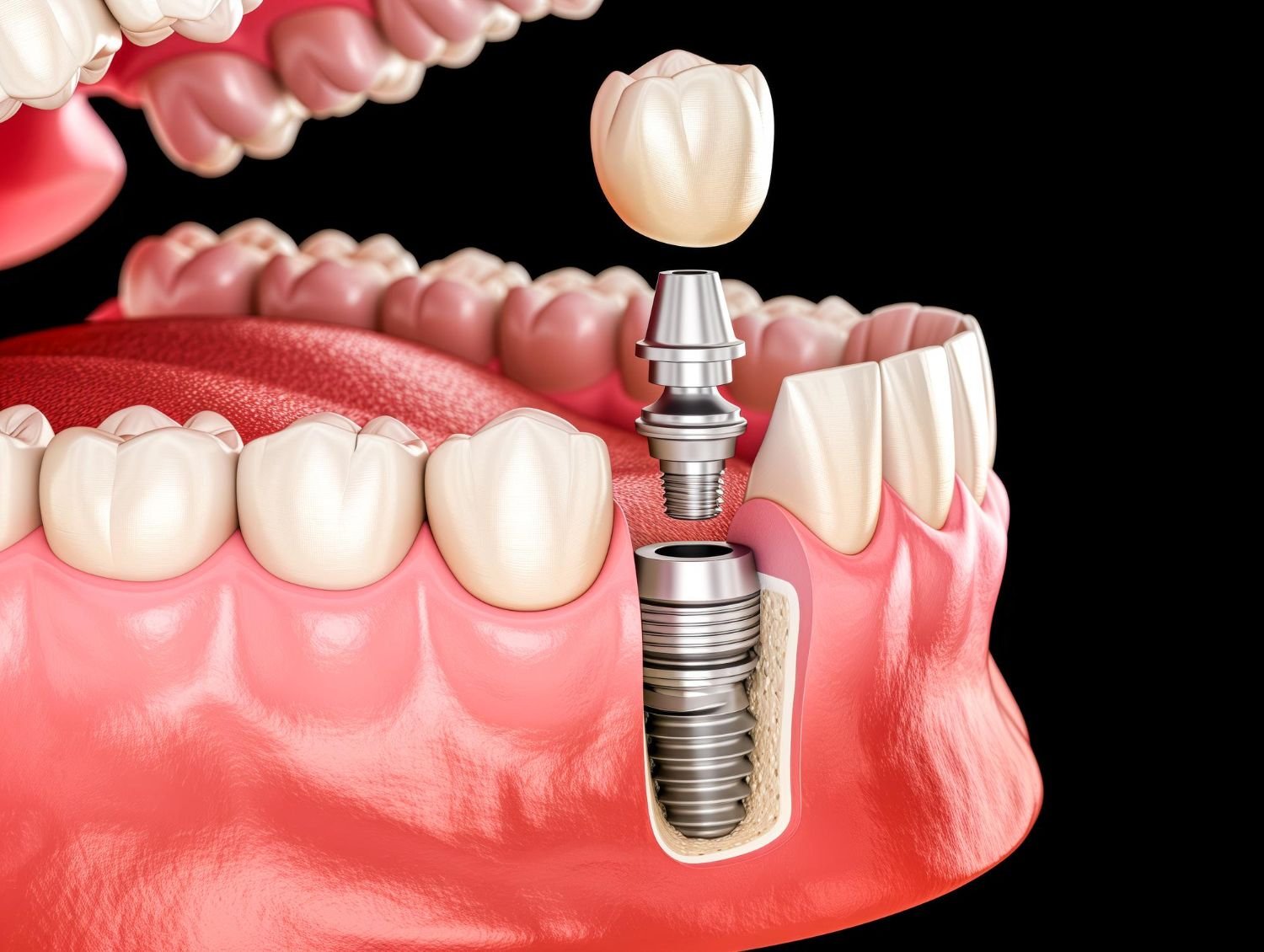 Dental Implants